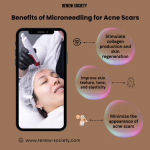 Benefits of Microneedling for Acne Scars 
