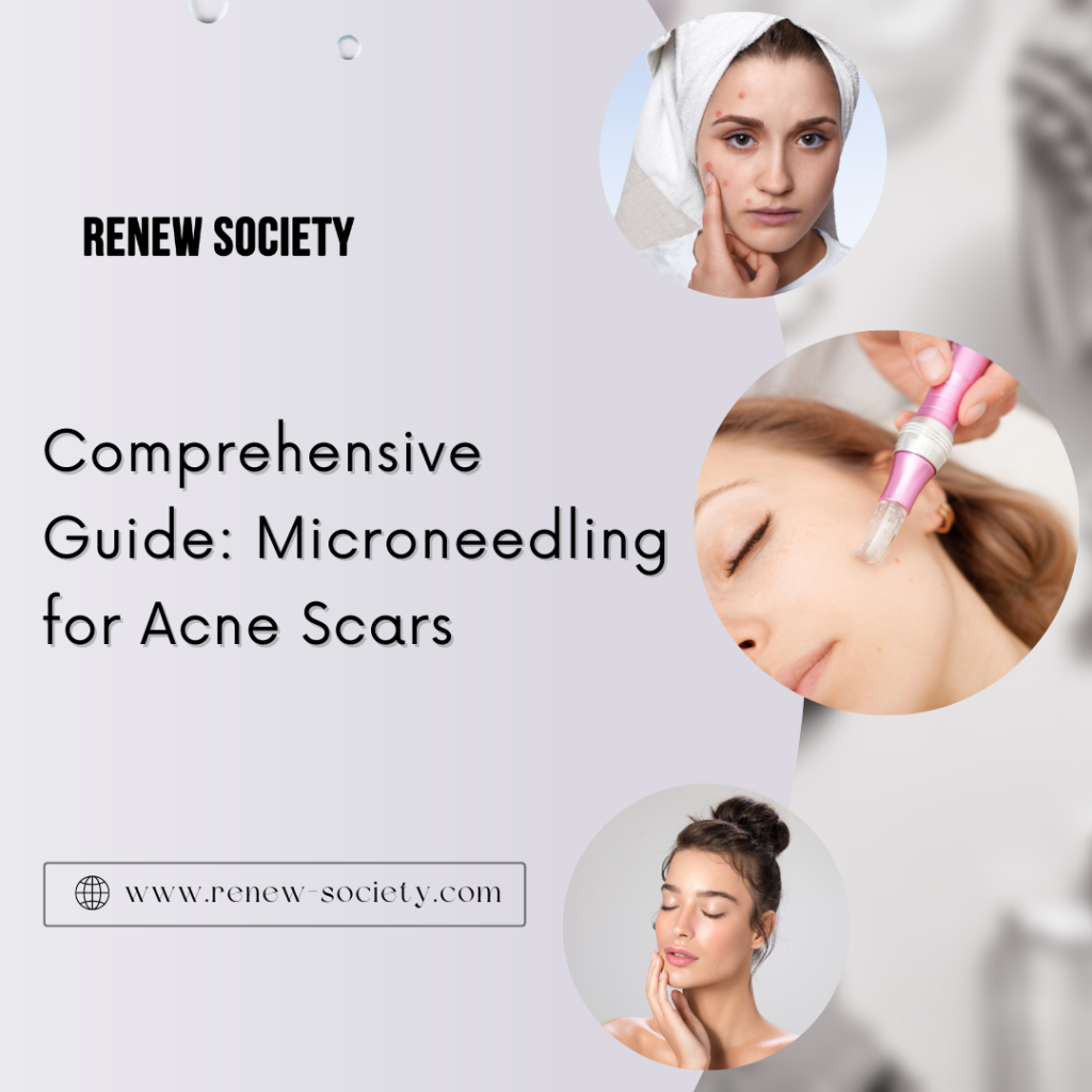 Comprehensive Guide Microneedling for Acne Scars McKinney, TX